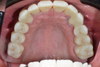 71mm ST+ White Zirconia Blocks