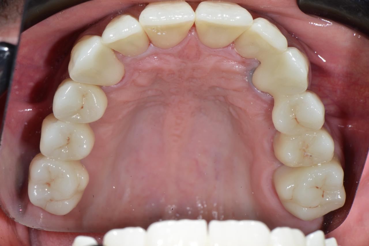 71mm ST+ White Zirconia Blocks
