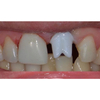 98mm HT White Zirconia Blocks